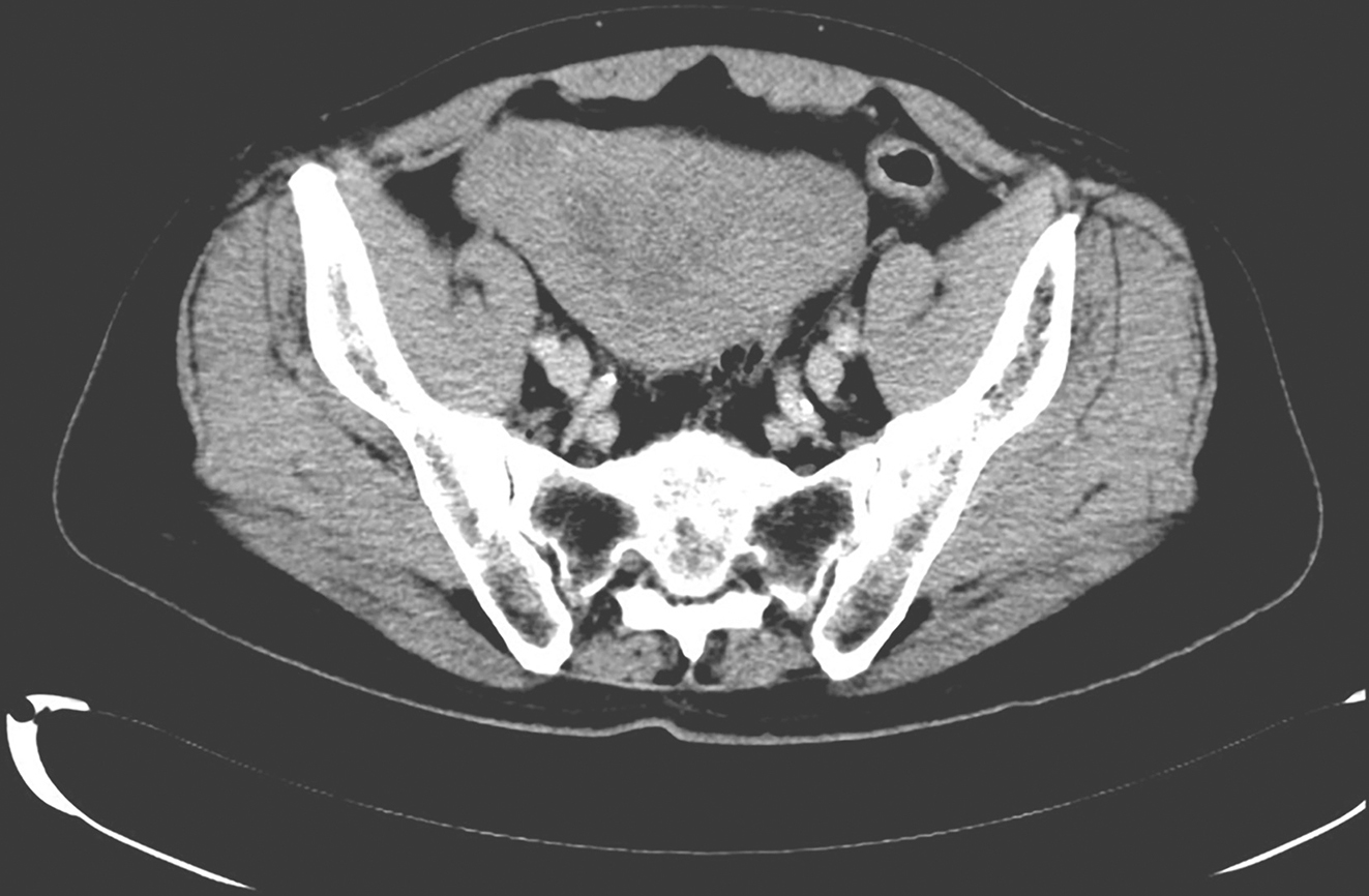 图4 服用伊马替尼6个月后复查腹盆腔增强CT.jpg